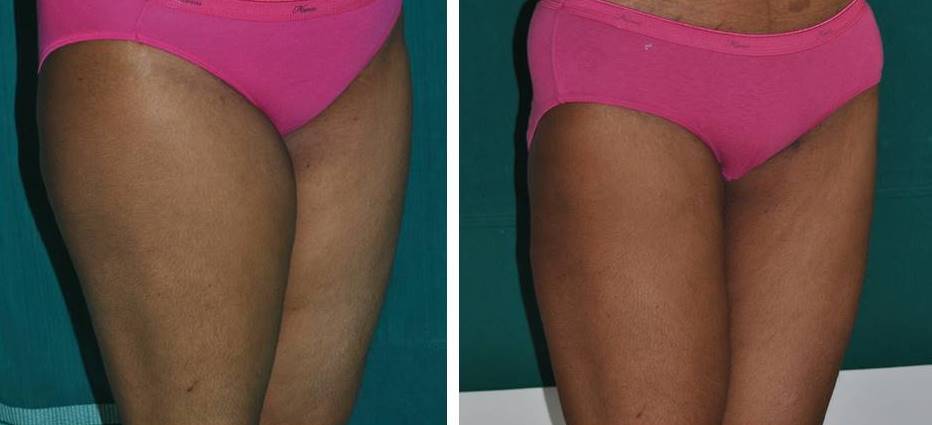 Liposuction of thighs